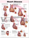 Heart Disease Anatomical Chart